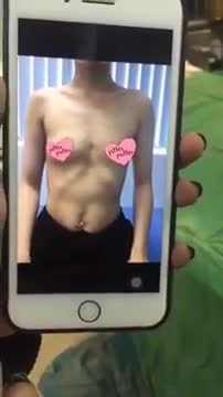 Nâng ngực size 340 cc đường chân ngực