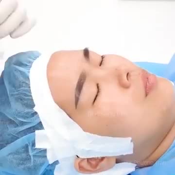 Phân tích cas KH chuẩn bị nâng mũi cấu trúc sụn sườn và cắt mí