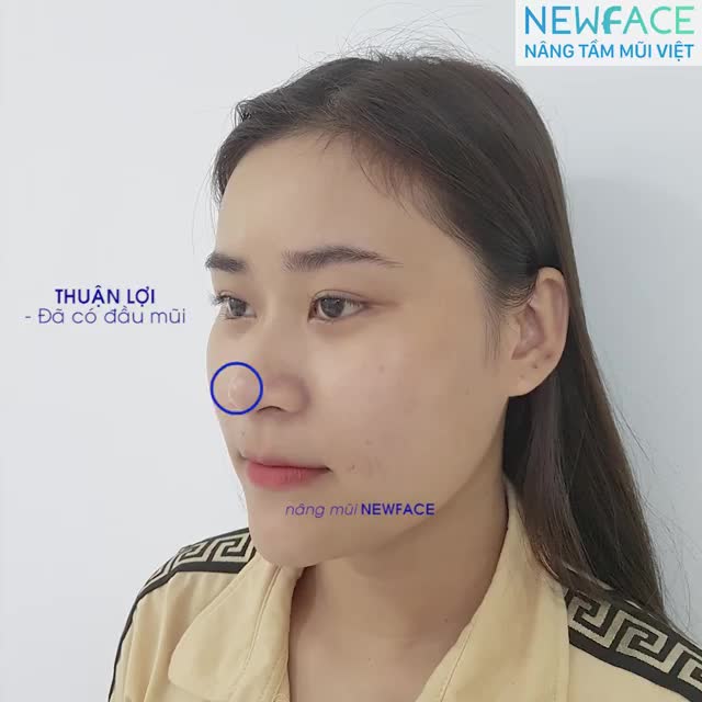 Cận cảnh mũi bạn Ngọc sau khi nâng