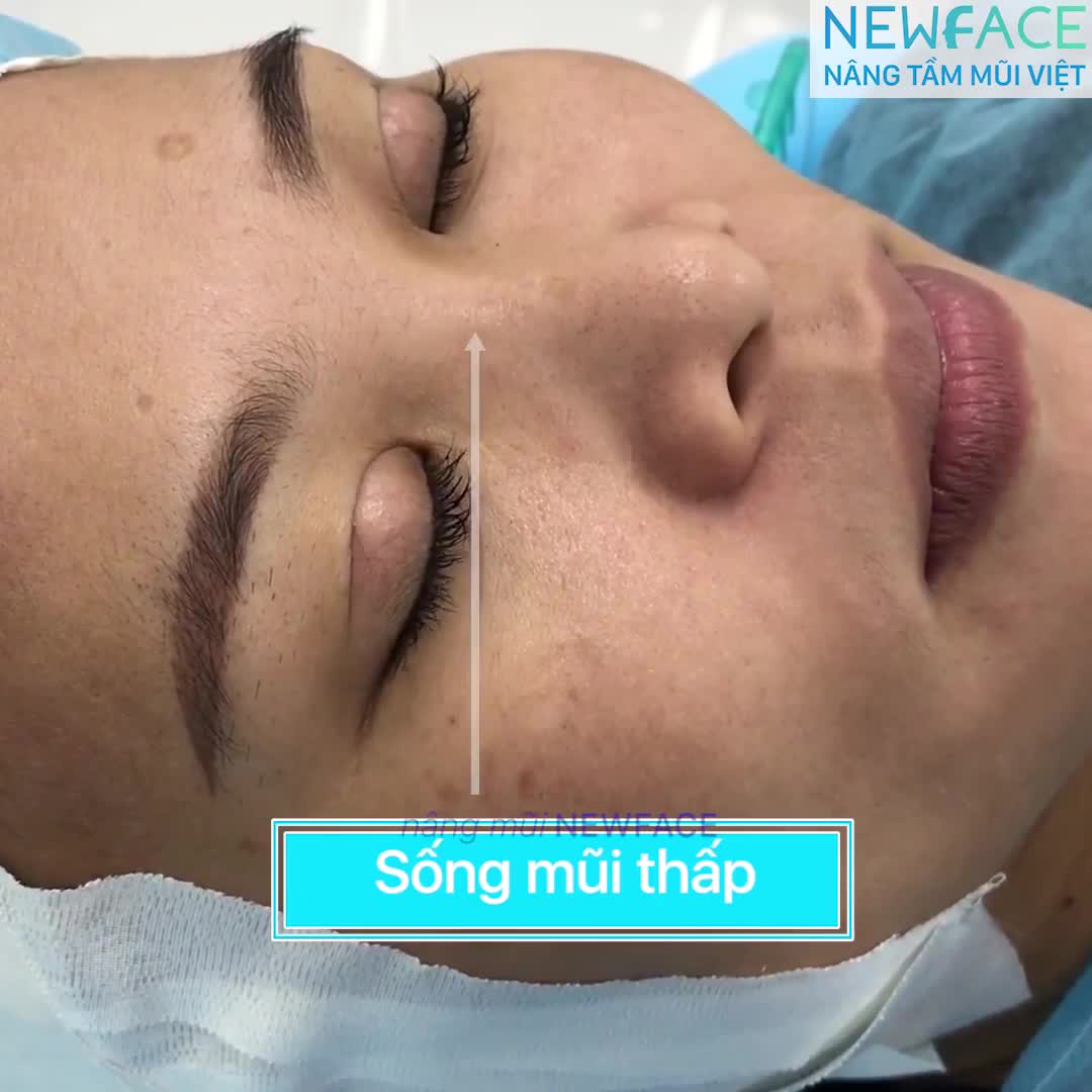 Nâng mũi cấu trúc vách ngăn nhân tạo