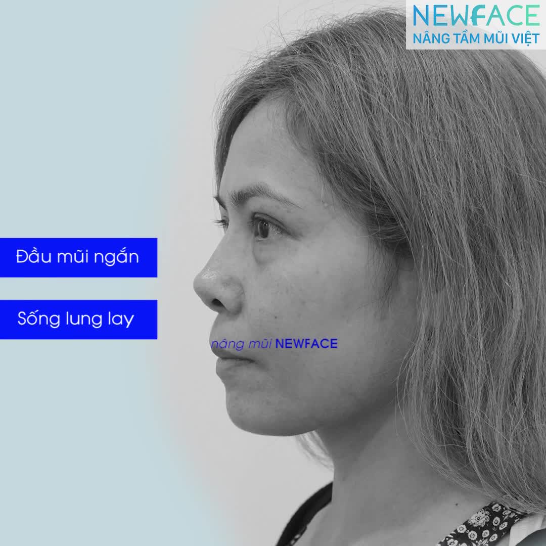 Tình trạng mũi lộ sống, lung lay đã được khắc phục hoàn toàn