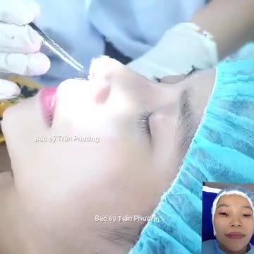 Cận cảnh cắt chỉ cho KH Kim Hằng sau 14 ngày nâng mũi cấu trúc