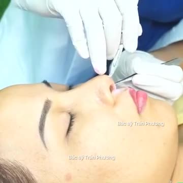 Chia sẻ của KH tới cắt chỉ sau nâng mũi 14 ngày