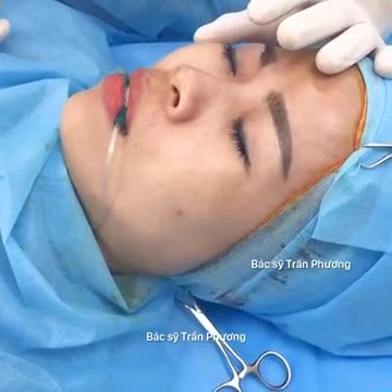 Cận cảnh bác sĩ bóc tách và tạo hình sống mũi
