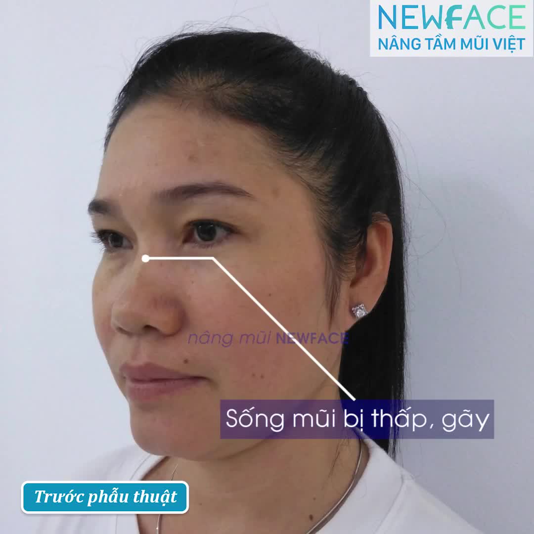 Cải thiện chiếc mũi gãy, hếch