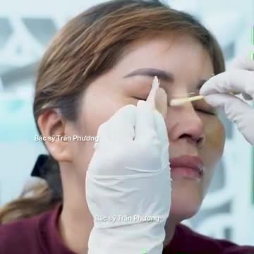 Cận cảnh tháo nẹp sau 7 ngày nâng mũi
