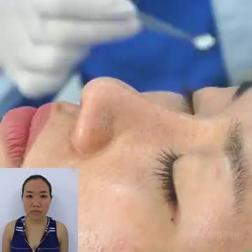 Giao lưu với KH Tường Vân sau 14 ngày nâng mũi cấu trúc