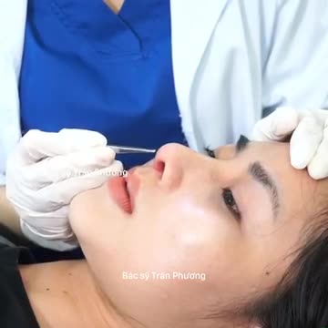 Gặp gỡ Tuệ Nhi - cô nàng nâng mũi được 14 ngày