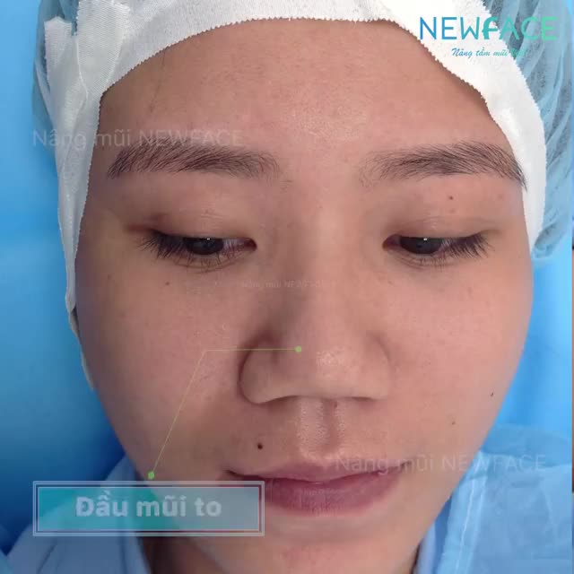 Gương mặt sang chảnh, sắc nét hơn sau nâng mũi cấu trúc