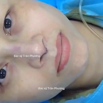 Chỉnh sửa mũi hỏng (p2 - kết quả)