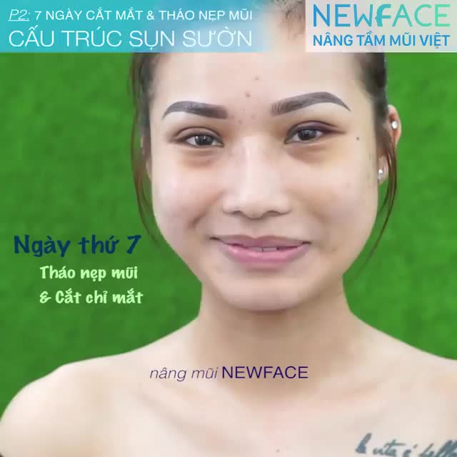 Câu chuyện nâng mũi, cắt mí của Hương Thảo (p.2)