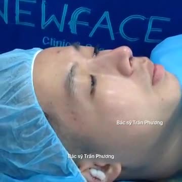 Kết quả nâng mũi trên KH nam