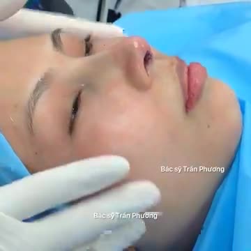 Hình ảnh KH trước và sau nâng mũi cấu trúc