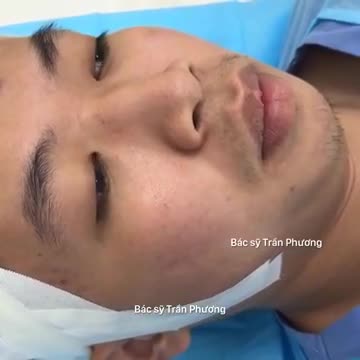 Nâng mũi cho nam giới có gì khác biệt?