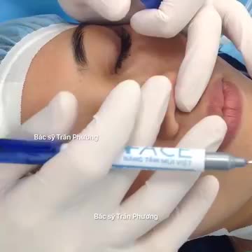 Phân tích trước nâng mũi
