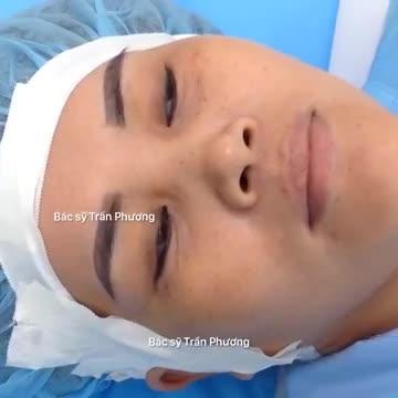 Phân tích trước phẫu thuật nâng mũi