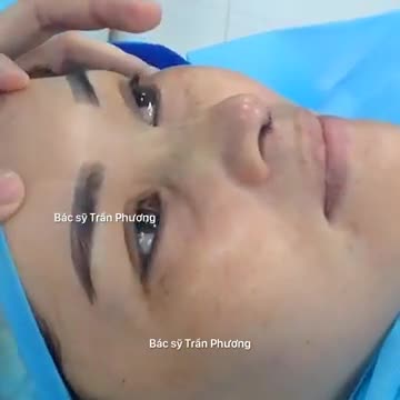 Trước và ngay sau nâng mũi cấu trúc