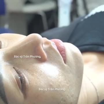 Trò chuyện với KH nâng mũi sau 14 ngày