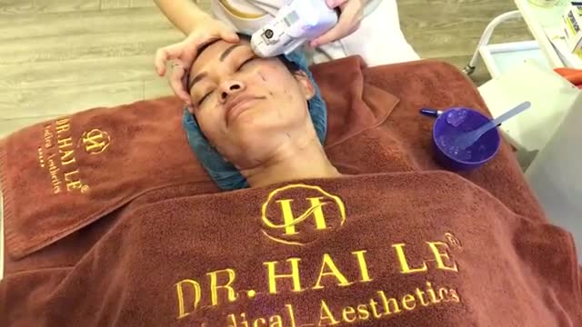 Nâng cơ mặt bằng công nghệ Ultherapy
