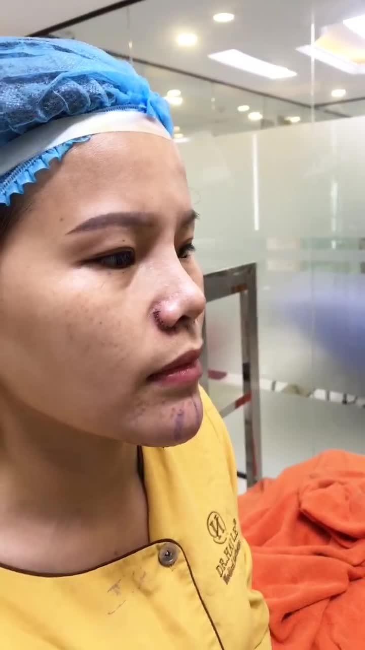 Độn cằm V line và mở thu cánh mũi