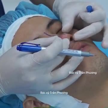 Câu chuyện nâng mũi của bạn Thắng (p.2)
