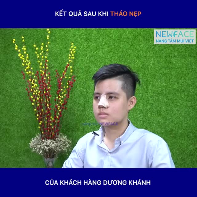 Câu chuyện nâng mũi của bạn Dương Khánh