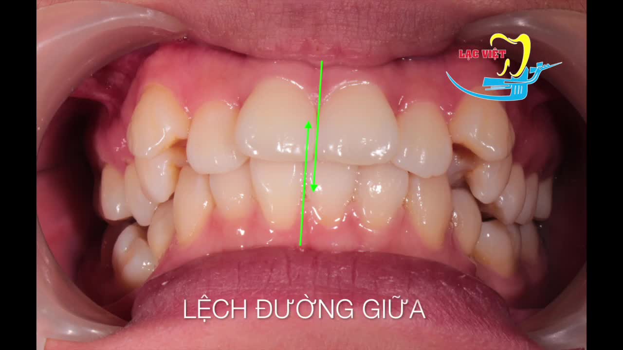 Cô gái tìm lại nụ cười tự tin tại Nha Khoa Lạc Việt