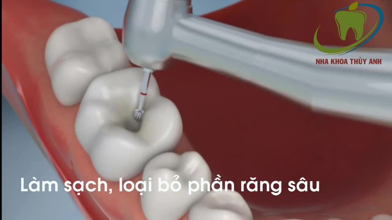 MÔ PHỎNG QUÁ TRÌNH HÀN RĂNG SÂU BĂNG COMPOSITE