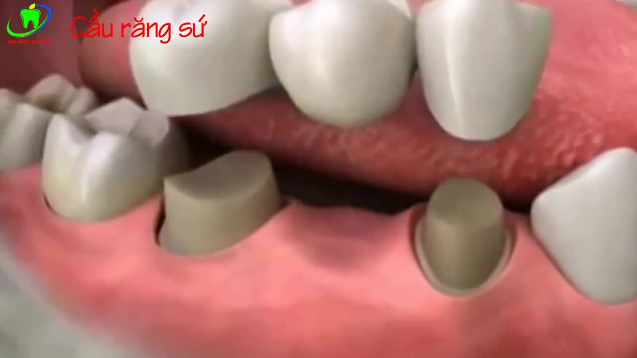 PHỤC HÌNH RĂNG MẤT BẰNG PHƯƠNG PHÁP CẦU RĂNG SỨ