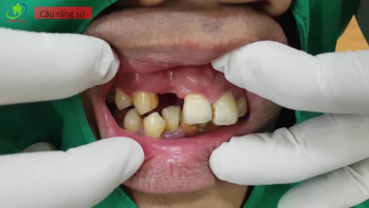 PHỤC HỒI RĂNG MẤT BẰNG PHƯƠNG PHÁP LÀM CẦU RĂNG SỨ TẠI NHA KHOA THÙY ANH