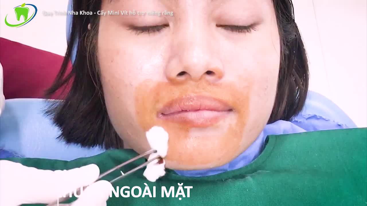 Procedure Show - Quy Trình Cắm Vít Kéo Hàm Hô Và Cười Hở Lợi