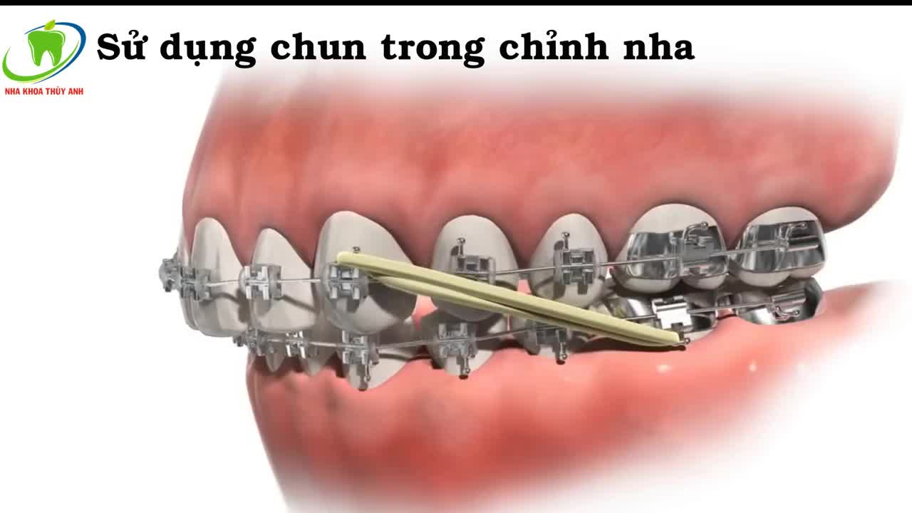 Sử dụng chun trong chỉnh nha