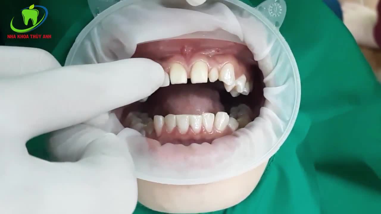 Thay đổi hình thể răng bằng Mặt Sứ Veneer