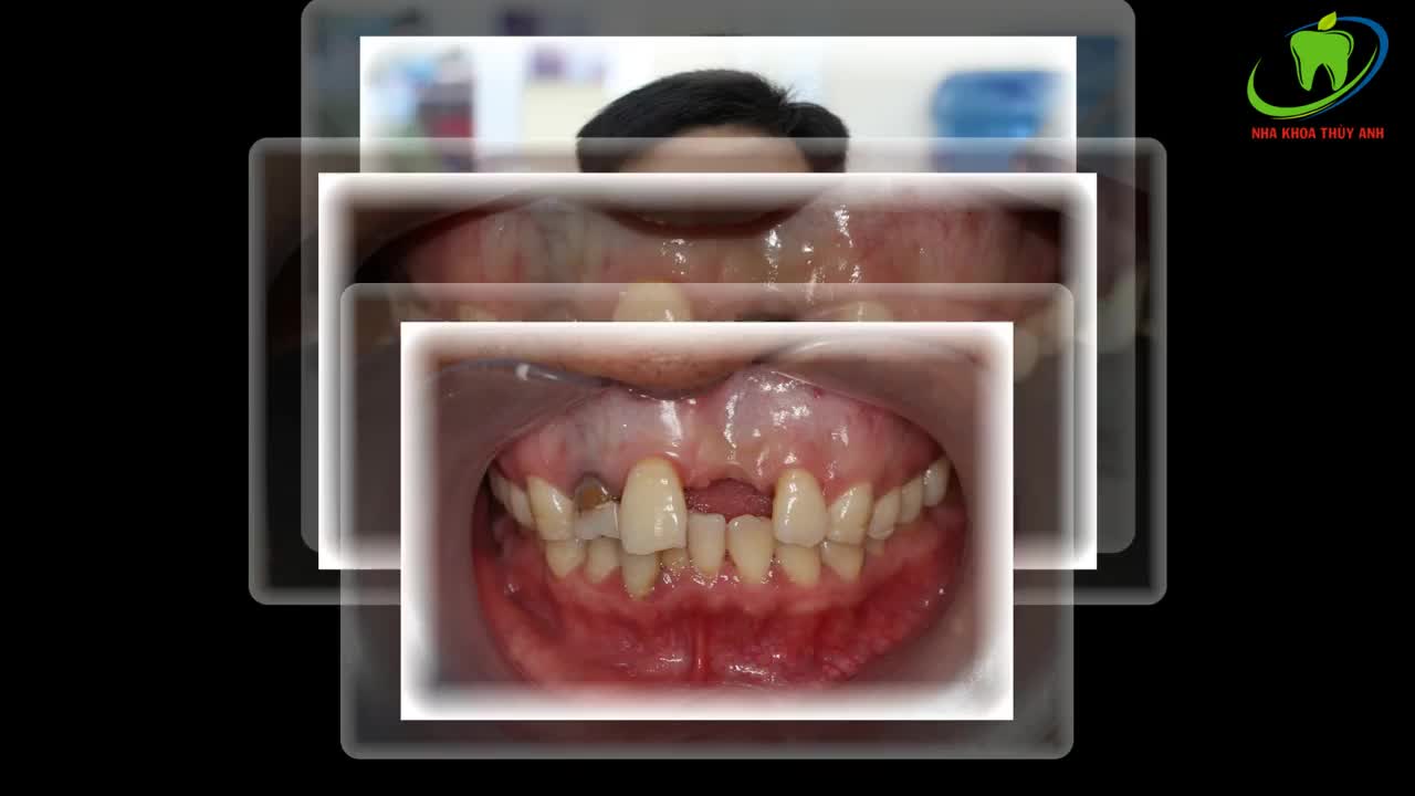 Trồng Răng Bắc Cầu chỉ với 2 lần hẹn tại NHA KHOA THÙY ANH