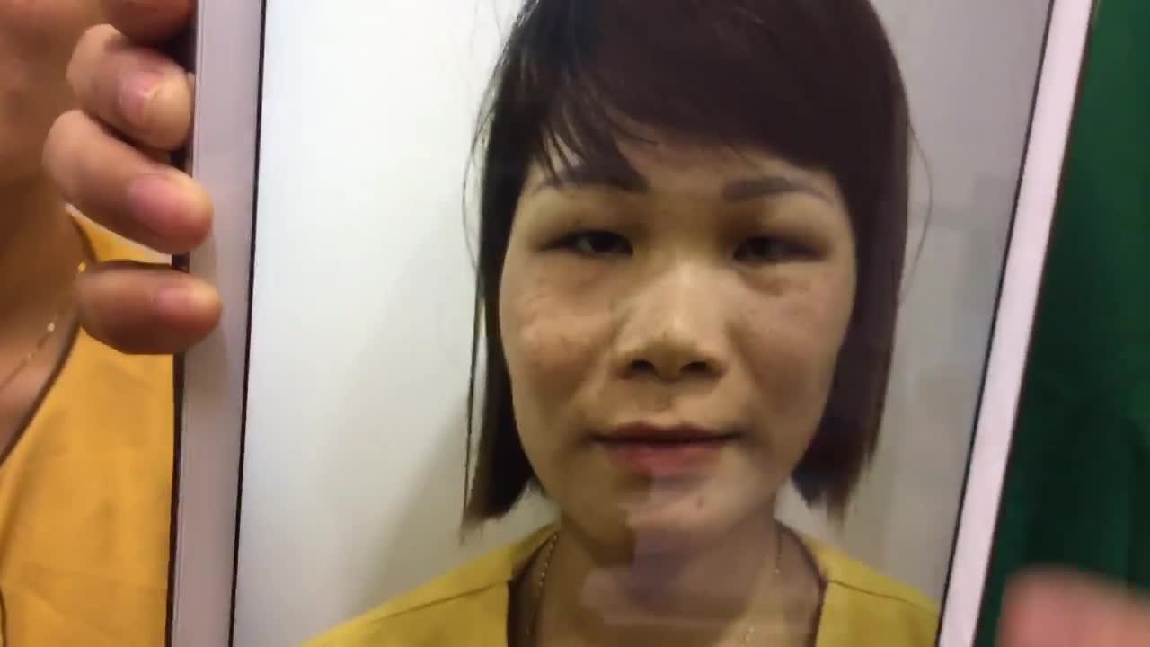 Cận Cảnh Ca Cắt Mí Mắt Siêu Khó Tại VTM Dr Hải Lê - Ca 41
