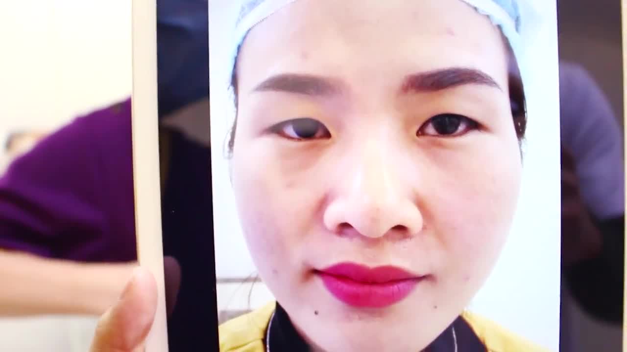 Cắt Mí Mani Mini Deep 10/03/2017 - VTM Y Khoa Dr.Hải Lê Ca 8