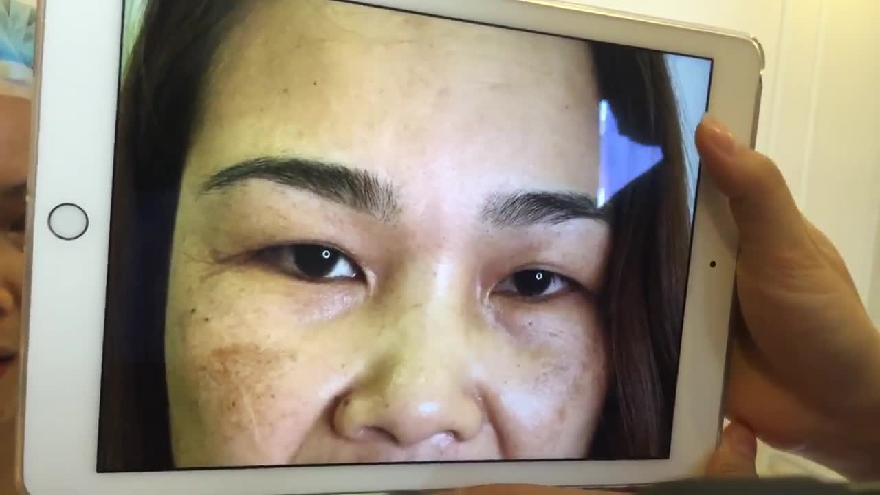 Cắt Mí Mắt Ngay Sau PT Tại VTM Dr Hải Lê - Ca 26