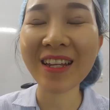 Đôi mắt đẹp hoàn hảo sau cắt mí dr hải lê