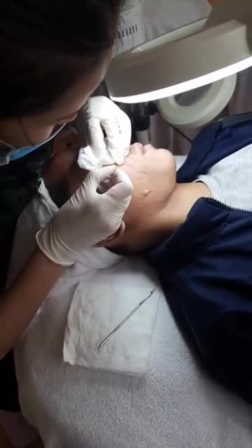 Trị mụn - Thẩm mỹ Kangnam - Ca 04
