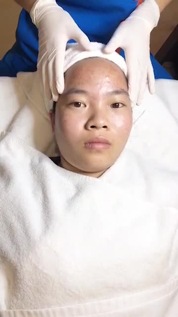 Trị mụn nano skin - Thẩm mỹ Kangnam - Ca 08