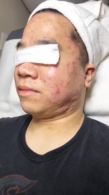Trị mụn nano skin - Thẩm mỹ Kangnam - Ca 07