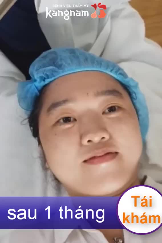 Trị tàn nhang - Thẩm mỹ Kangnam - Ca 03