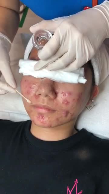 Trị mụn nano skin - Thẩm mỹ Kangnam - Ca 06