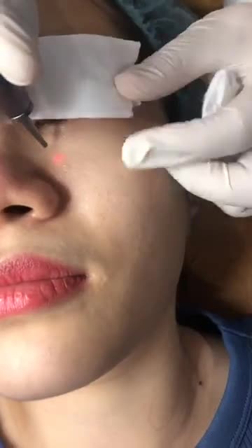 Trị mụn thịt - Thẩm mỹ Kangnam - Ca 04