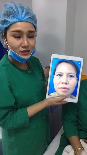 Xóa rãnh lệ và cấy mỡ Nano fat - Thẩm mỹ Kangnam - Ca 19