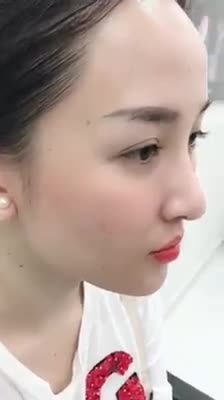 Combo nâng mũi, độn cằm - Bác sĩ Mã Hiệp - Ca 33