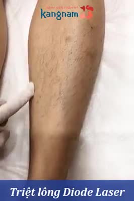 Triệt lông Diode Laser - Thẩm mỹ Kangnam - Ca 02