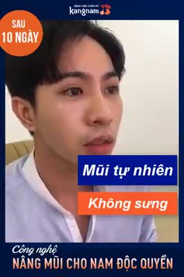 Nâng mũi cấu trúc 4D dáng L-line - Thẩm mỹ Kangnam - Ca 48