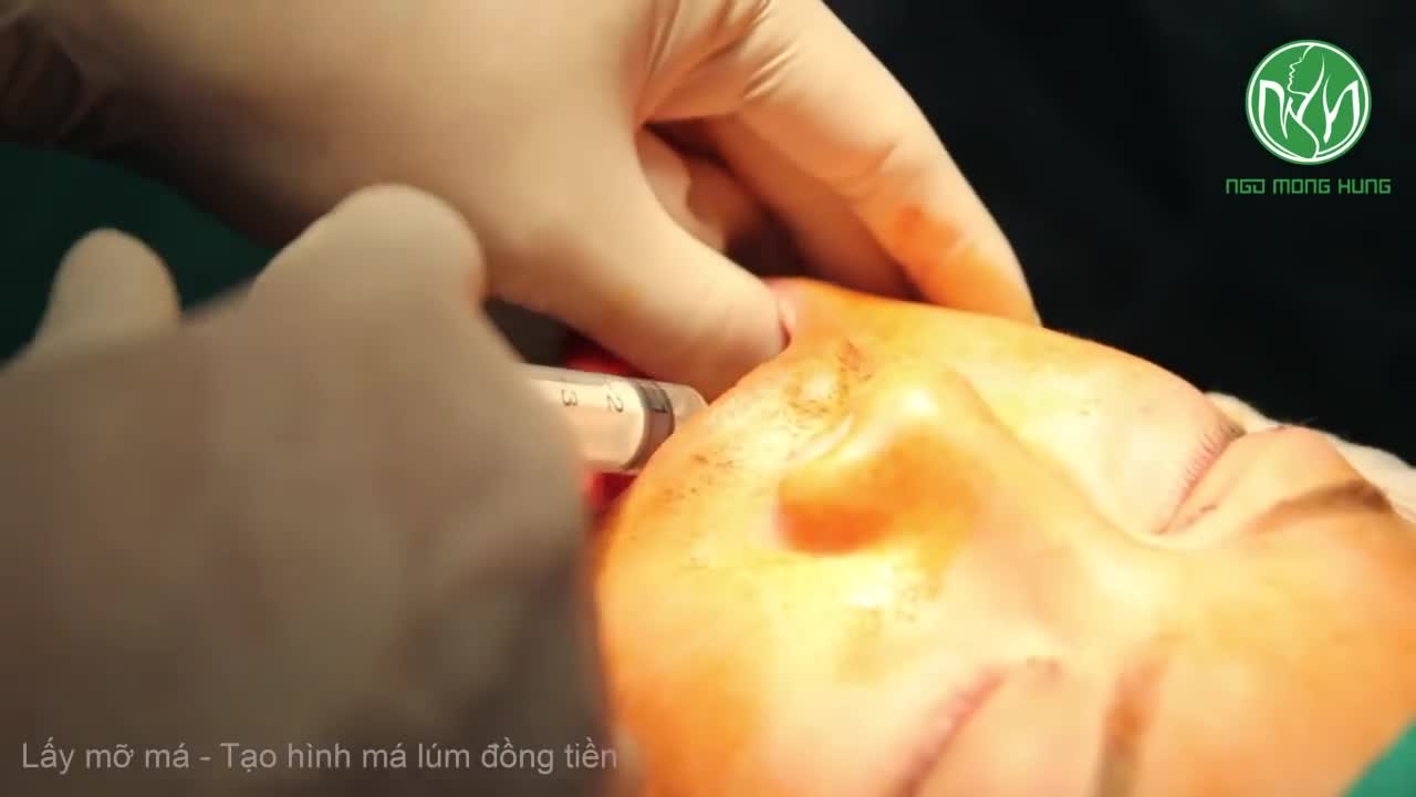 Lấy mỡ má, tạo má lúm đồng tiền - Bs Ngô Mộng Hùng