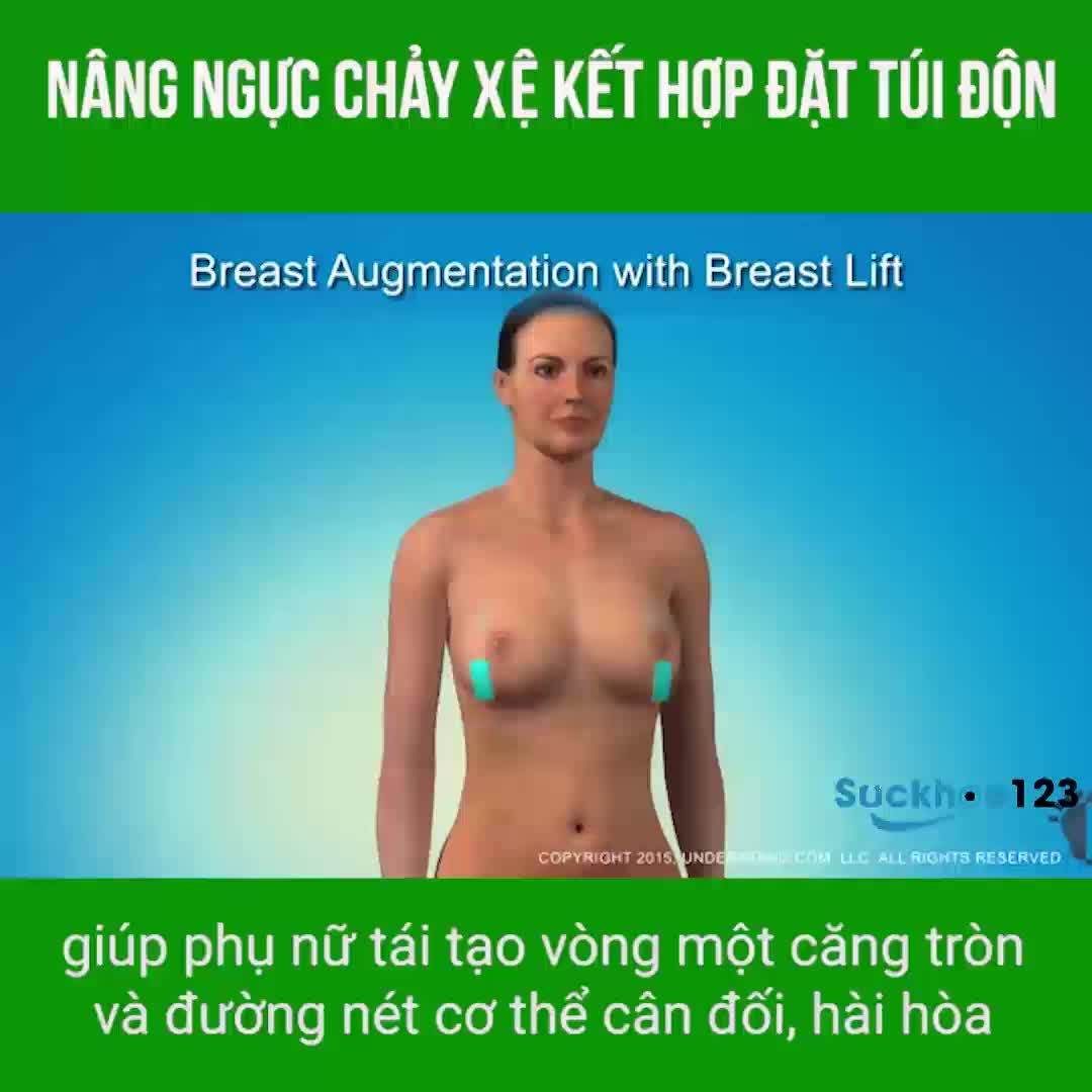 Đặt túi độn kết hợp nâng ngực chảy xệ